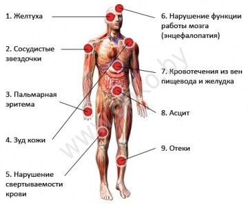 Что поражает цирроз Органы поражаемые циррозом и признаки цирроза