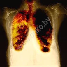 Рентген-снимок рака легкого