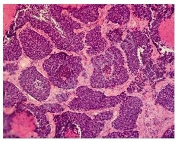 Мелкоклеточный рак легкого под микроскопом