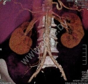 Рентген снимок рака почки